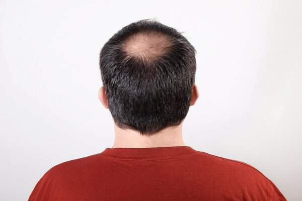 Hair Restoration with PRP Male hair Thinning